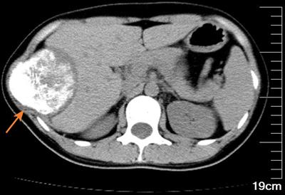 Case Report: Cavernous hemangioma of rib: an extremely rare venous malformation but easily misdiagnosed as aggressive tumors
